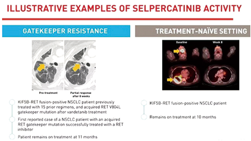 RET融合阳性NSCLC Selpercatinib疗效持久且颅内有效