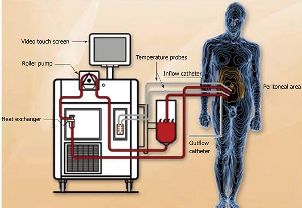 结肠直肠癌腹膜转移 减瘤术加高温腹膜内化疗或无生存获益 