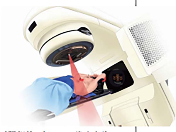 全乳放疗同步瘤床加量治疗总体安全