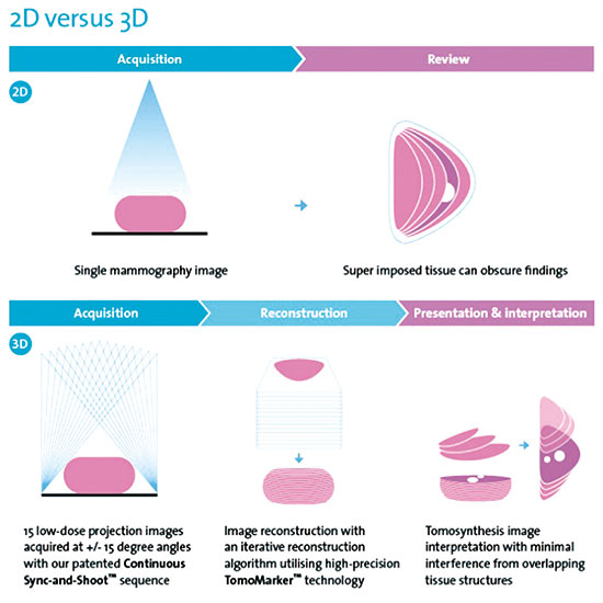 研究表明3D钼靶是更准确的乳腺癌筛查方法