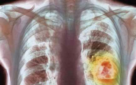 中国肺癌临床病理特征和手术治疗的十年