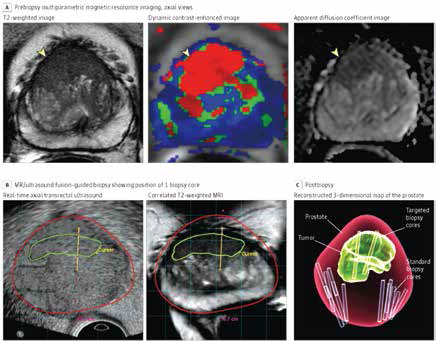 前列腺癌 mp-MRI、MRI引导的活检及系统活检均可区分高危病理特征