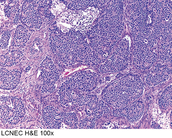 免疫检查点抑制剂对LCNEC的疗效类似NSCLC