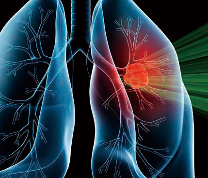 一线治疗晚期非鳞状NSCLC 含铂化疗联合信迪利单抗或改善生存