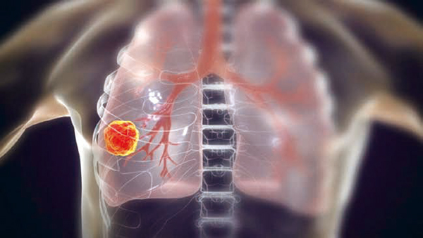 一线治疗ALK阳性晚期NSCLC Ensartinib或优于克唑替尼