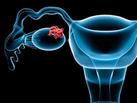 BRCA1/2基因突变携带者 输卵管切除术后生活质量仍较优