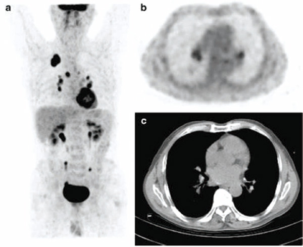 最大径10.1~30.0 mm的实性NSCLC 术前CT和SUVmax预测纵隔淋巴结转移不敏感