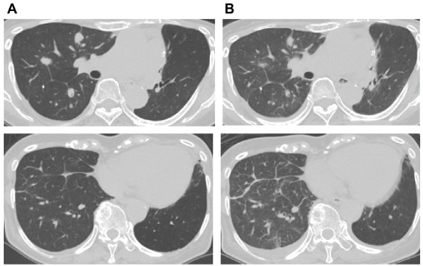 一线治疗NSCLC 奥希替尼相关性肺炎发生率为 18%