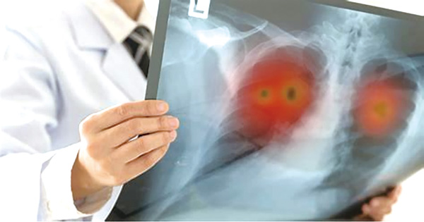 无驱动基因突变Ⅱ~Ⅲ期NSCLC 联合Adebrelimab的新辅助方案或较佳