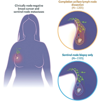 前哨淋巴结转移乳腺癌 不接受腋窝淋巴结清扫不劣效于手术