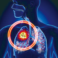 不可切除的Ⅲ期NSCLC 新辅助应用阿替利珠单抗值得研究