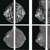 高风险人群 对比增强乳腺摄影可检出更多乳腺癌