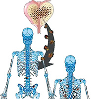 高危局限性或转移性激素敏感性前列腺癌 唑来膦酸可降低转移患者长期骨折风险