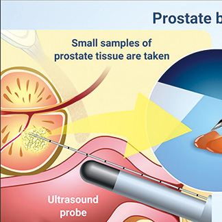 活检GG1前列腺癌具有异质性的长期结局