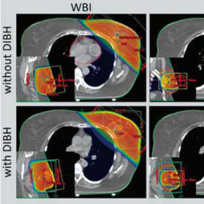 早期乳腺癌 选择部分乳房照射方式需谨慎