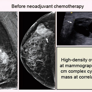 HER2阳性乳腺癌 基于MRI的新辅助周期个性化调整生存结局良好